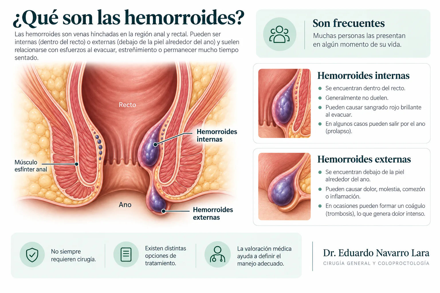 Ilustración médica que compara hemorroides internas y externas y señala el recto, el ano y el músculo esfínter anal